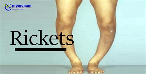 what part of the body does rickets affect