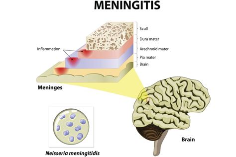 what pathogen causes meningitis