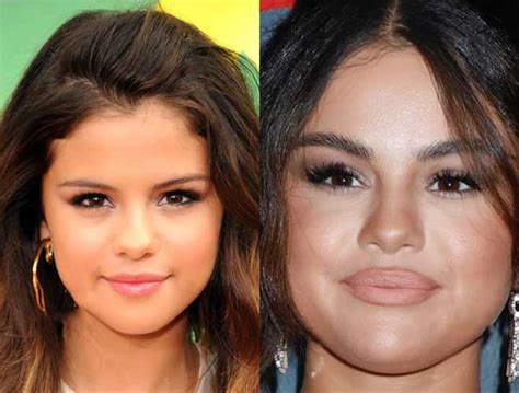 what surgery did selena gomez have
