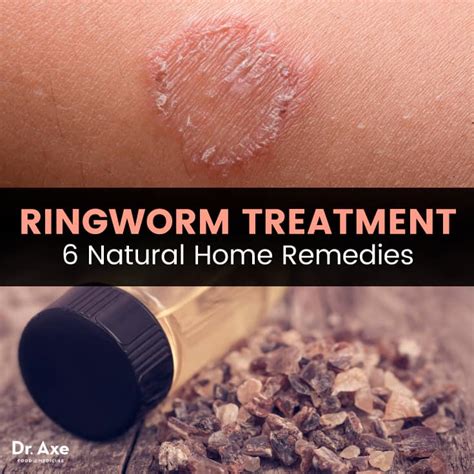 What Temperature Kills Ringworm