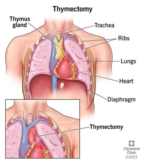 What Thymectomy Meaning