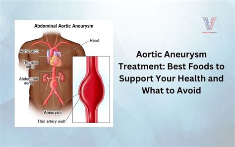 What To Avoid With Aneurysm