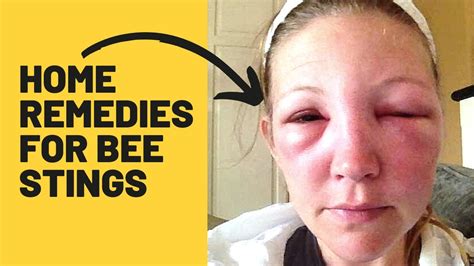 what to do for a swollen bee sting on face