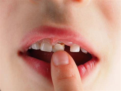 what to do for a wiggly tooth