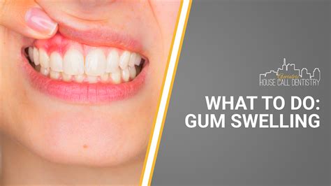 what to do for gum swelling