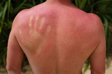 What To Do If Burnt From Sunbed