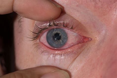 what to do if cornea is scratched