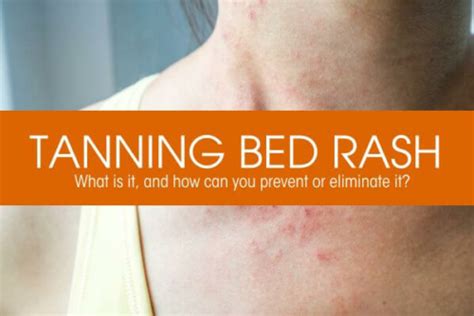 What To Do If You Get Burned In Tanning Bed