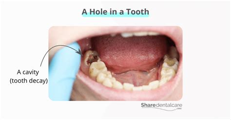 what to do if you have a hole in your tooth and it hurts