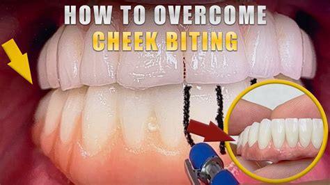 What To Do When Bite Cheek