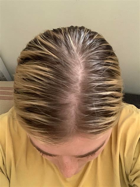 Perfect What To Do With Thinning Hair Reddit For New Style