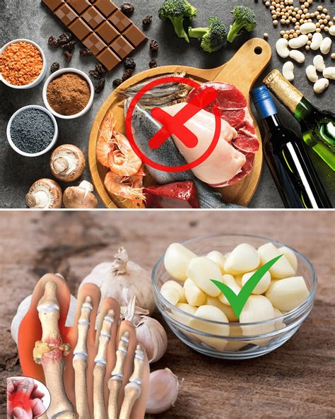 What To Eat When Suffering From Gout