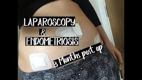 what to expect after endometriosis surgery