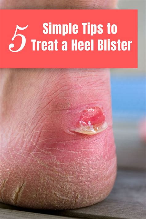 what to put on a busted blister