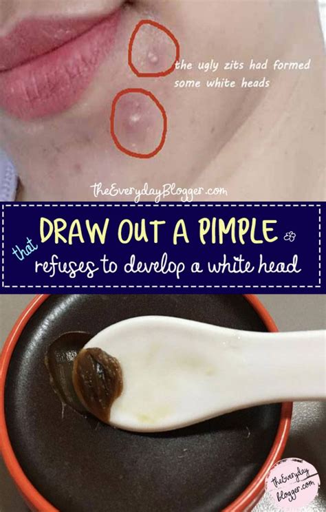 what to put on a pimple to draw it out