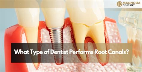 Dentist Edmonton Alberta Will it hurt to get a root canal?