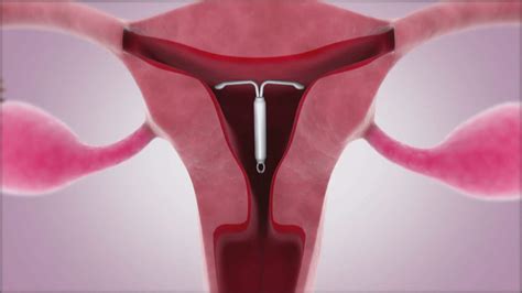 what type of iud is mirena