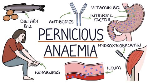 what vitamin deficiency causes pernicious anemia quizlet