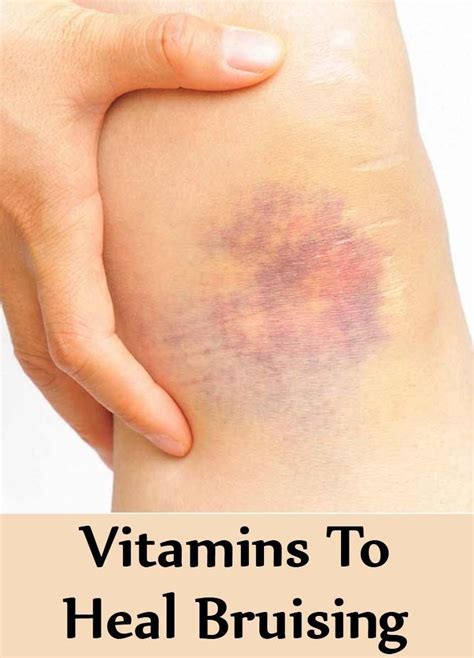 what vitamins help with bruises