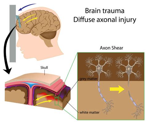 What does diffuse TBI mean?