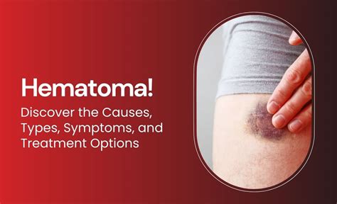 Understanding Whats a Hematoma: Causes, Symptoms, and Treatment Options
