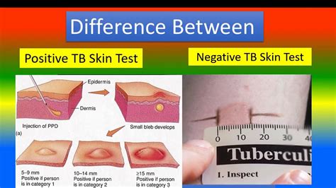 Understanding What's a TB Test: A Comprehensive Guide Inside