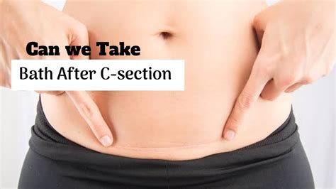 When Can U Bath After C Section