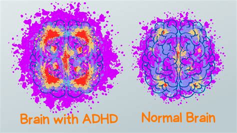 when do adhd brains fully develop