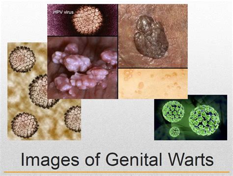 when do genital warts appear