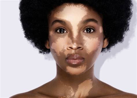 when does vitiligo develop