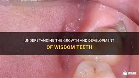 when is wisdom teeth grow