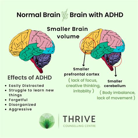 when is your brain fully develop with adhd