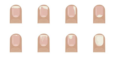 When Nail Separates From Nail Bed