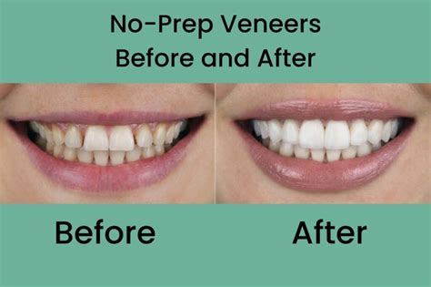 When Not To Get Veneers