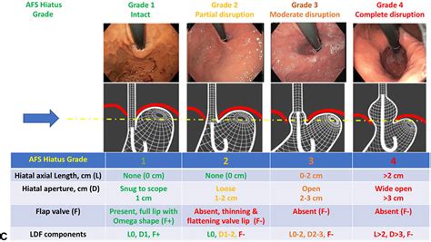 When To Get Endoscopy For Gerd