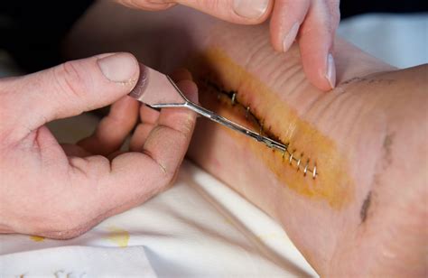 Cut Deep: When to Get Stitches for a Wound