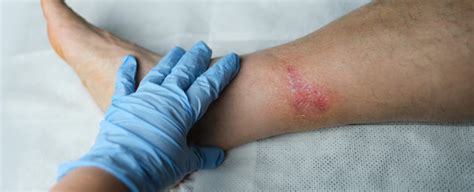 When To See A Doctor About A Scrape