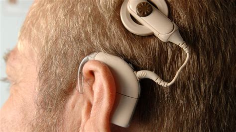 when were cochlear implants invented