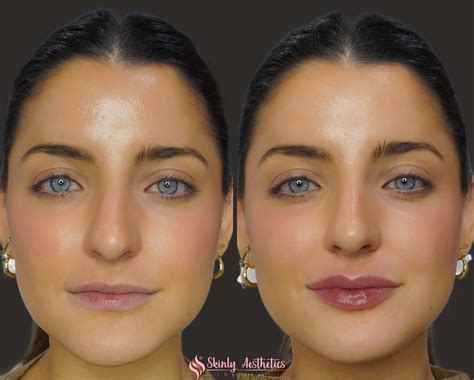 When Were Lip Injections Invented