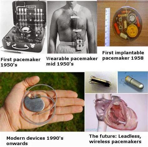when were pacemakers first invented