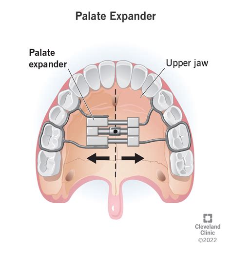 When Were Palate Expanders Invented