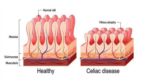 When does celiacs disease develop?