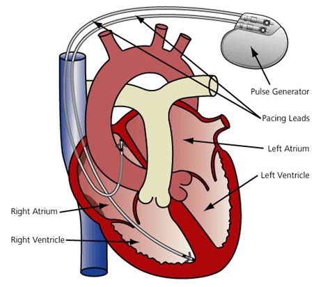 where do pacemaker leads sit