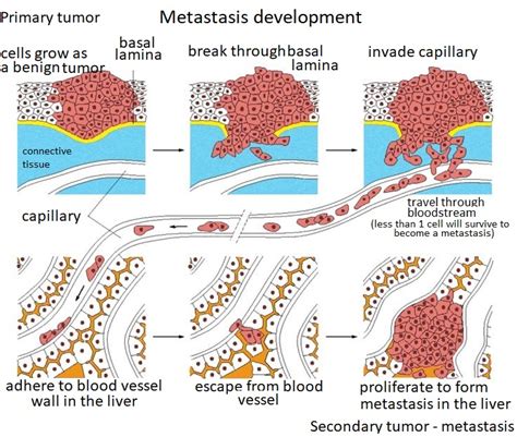 where does cervical cancer metastasis to