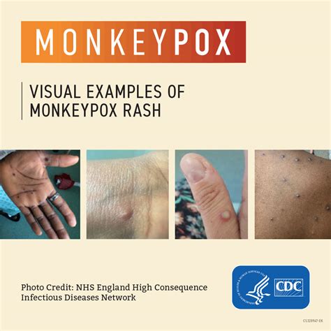 where does monkeypox rash start