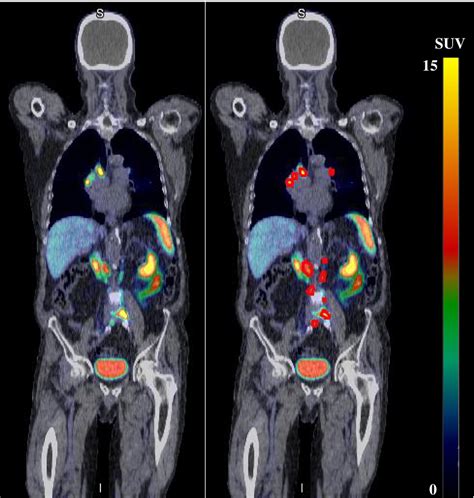 where is the psma pet scan available