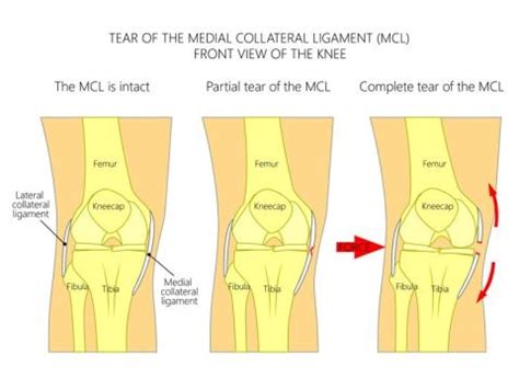 Understanding Your Knee: Where is Your MCL and What Does it Do?