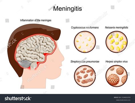 where meningitis is found