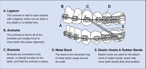 Where Should Brackets Be Placed On Teeth