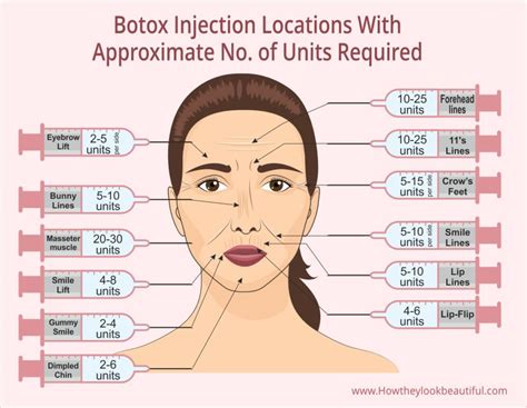where to get botox injections on your face